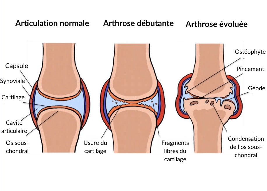 ARTHROSE