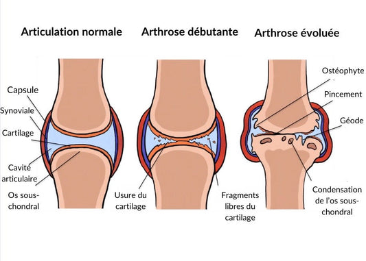 ARTHROSE